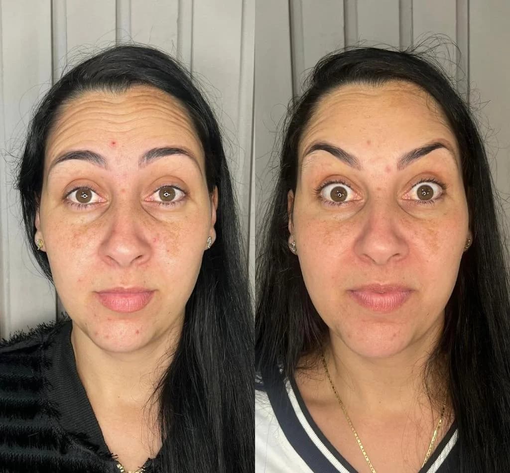 Imagem de antes de um tratamento com botox